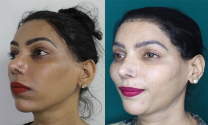 Non surgical facelift